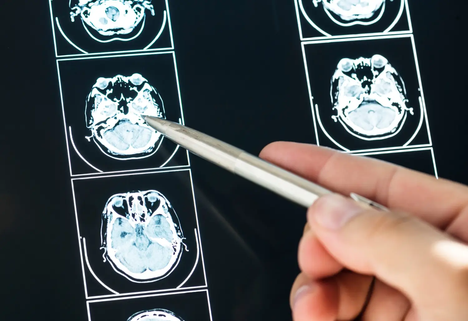 A neuropsicologia de Luria

Foto de um exame de imagem do cérebro, composto por diversas imagens diferentes em uma folha de filme radiográfico. Uma pessoa está segurando uma caneta de metal e apontando para uma dessas imagens.

A foto representa os novos exames de imagem que auxiliam a neuropsicologia. A neuropsicologia de Luria, integrada à clínica vigotskiana, propõe uma abordagem que considera o sujeito em sua totalidade — corpo, mente, história e contexto social. Superando modelos reducionistas, Luria desenvolveu a teoria dos sistemas funcionais dinâmicos, onde funções mentais superiores emergem da interação entre cérebro e cultura. Na prática clínica, essa perspectiva permite compreender o psiquismo para além do diagnóstico, favorecendo intervenções mais humanas e eficazes, baseadas na história e vínculos sociais do sujeito.